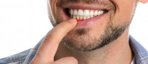 manotick dentist - What is the difference between Gingivitis and Periodontitis