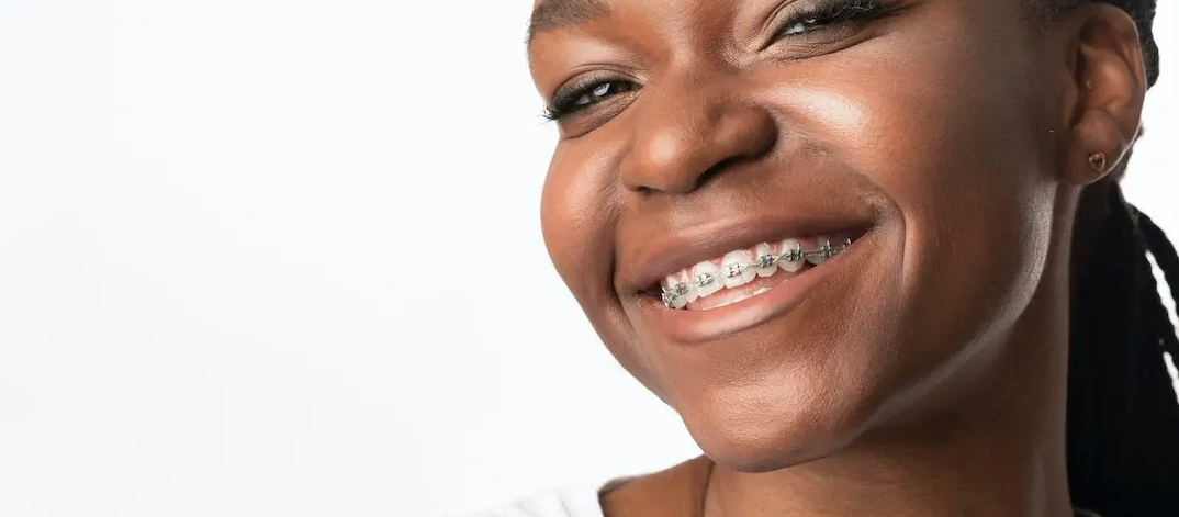 Benefits of Manotick Dental Braces | Manotick Main Dental